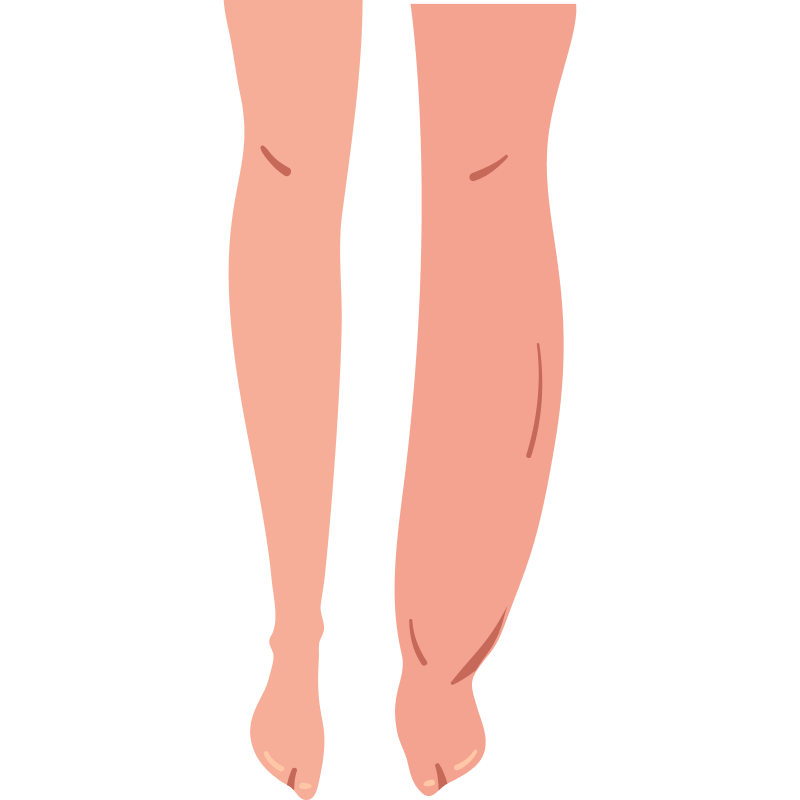 Legs with moderate swelling, visible on the lower legs and ankles. Legs with moderate swelling, visible on the lower legs and ankles.